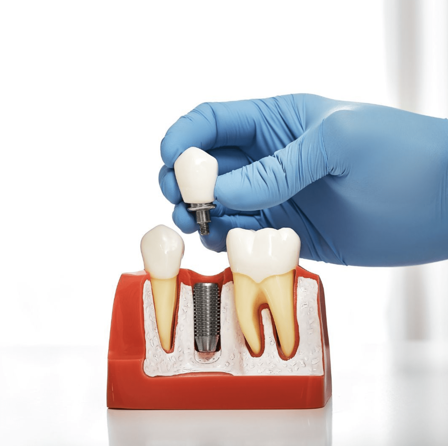 Implantes dentales en Aranjuez